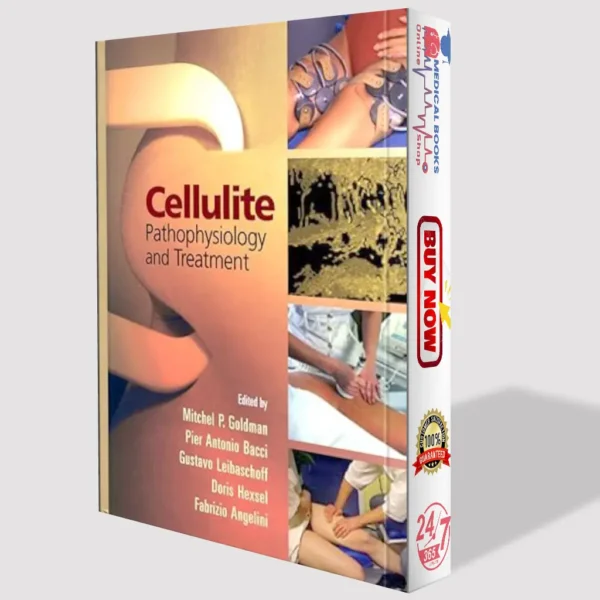 Cellulite: Pathophysiology and Treatment